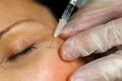 Botulism cases tied to Botox injections at Milton spa, state warns