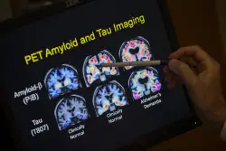 FDA approves blood test that can help diagnose Alzheimer’s disease